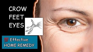 Crow Feet Eyes  Crow के पांव जैसे WRINKLES at corner of the Eyes  what Why amp Treatment [upl. by Eceinaj]