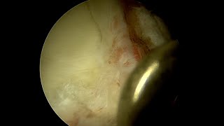 Previously Repaired Labrum with Multiplanar Grade 3 Complexity [upl. by Elita171]