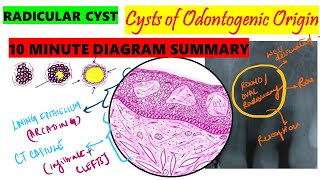 Radicular Cyst 10 MINUTE SUMMARY HISTOPATHOLOGY  Clinical features  Etiopathogenesis  Oral path [upl. by Anaugal250]