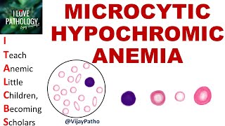 MICROCYTIC HYPOCHROMIC ANEMIA Causes Mechanism amp Approach [upl. by Meean]