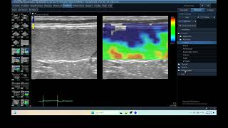 IQ 284 SPLEEN ELASTOGRAPHY GI BLEEDING ULTRASOUND ECHOPAC ANALYSIS [upl. by Yojenitsirk131]