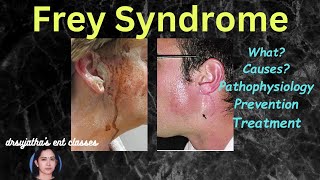 226 Freys Syndrome Information Prevention Treatment Explained dentallectures [upl. by Anialeh905]