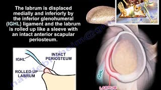 Lesions Of The Shoulder ALPSA lesion  Everything You Need To Know  Dr Nabil Ebraheim [upl. by Aholla]