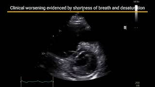 Bilateral Massive Pulmonary Thromboembolism [upl. by Gil]