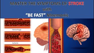 BE FAST Recognizing Stroke Symptoms With Fraterne ZU [upl. by Notsgnik]