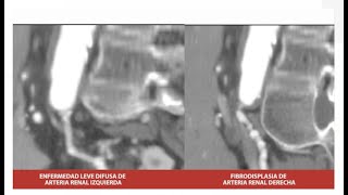 Angioplastia renal a fibrodisplasia de arteria renal derecha [upl. by Kerat856]