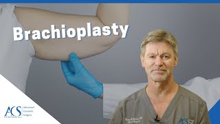 Brachioplasty Surgery Explained By Plastic Surgeon What is it Scars Recovery and More [upl. by Diarmuid463]