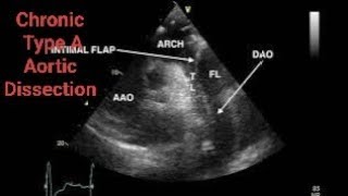 Chronic Type A Aortic Dissection CTAD Echocardiography post AVR [upl. by Giffer]