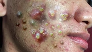 Big Cystic Acne Blackheads Extraction Blackheads amp Milia Whiteheads Removal Pimple Popping  228 [upl. by Niamjneb]