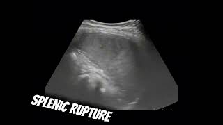 Splenic rupture [upl. by Naols]