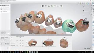 3Shape Ortho Analyzer  How to Use the Bracket Placement Workflow [upl. by Eserahs320]