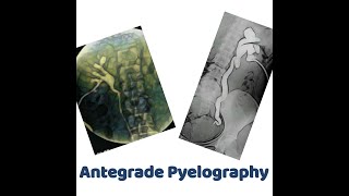 antegrade Pyelography [upl. by Anitsirhcairam976]