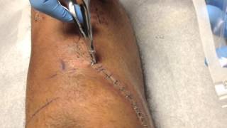 Complex Fracture Recovery Update  Staples and stitches removed [upl. by Noslien227]