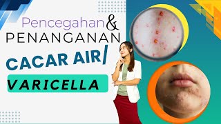 Cacar airVaricella varicella youtube [upl. by Reggis]