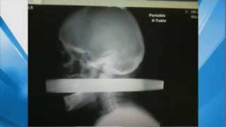 XRay Man Impaled by Pipe in Head Survives [upl. by Elyrad]