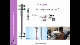 allongement osseux par clou PRECICE en 2021 indications et principes [upl. by Ellekcim]