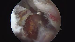 Arthroscopic ACJ stabilization and Bankart repair [upl. by Retse]