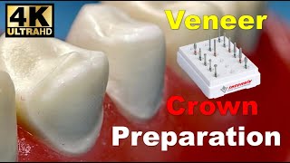 Veneer and Crown Prep StepbyStep [upl. by Annaul793]