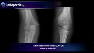 Elbow ossification centers CRITOE  radiology video tutorial [upl. by Lechner]