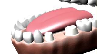 Dental Bridges [upl. by Eidua]