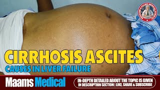 Ascites Fluid Buildup Causes Symptoms and Treatment  Maams [upl. by Isaiah]