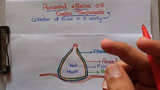 Pericardial Effusions or cardiac tamponade cause aspirationdrainage techniques [upl. by Syah486]