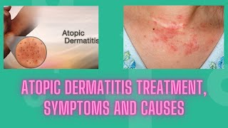 Atopic dermatitis treatment symptoms and causes  Nuse Healthy [upl. by Yekcaj873]