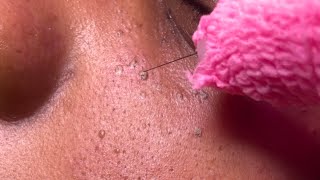 DPN Dermatosis Papulosa Nigra Removal [upl. by Yellhsa]