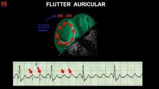 CURSO DE ELECTROCARDIOGRAFIA 55  FLUTTER Y FIBRILACIÓN AURICULARES [upl. by Oric]