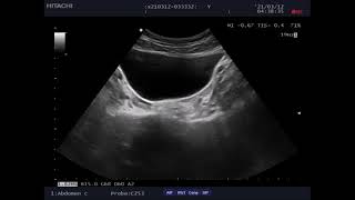 Hemorrhagic ovarian cyst rapture [upl. by Curson]