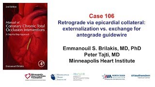 Case 106 Manual of CTO interventions Retrograde via epicardial collateral [upl. by Thibaut]