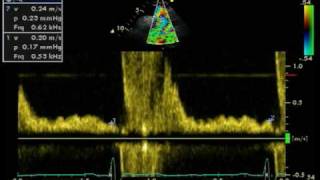 REVERSE DIASTOLIC FLOW  DESCENDING AORTA [upl. by Whitehurst877]