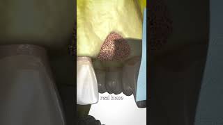 How Does Bone Graft Work [upl. by Mahon30]