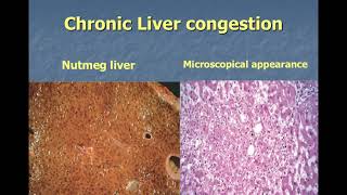 Hyperemia and Congestion [upl. by Pattin]