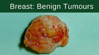 Breast Benign Tumours  Pathology mini tutorial [upl. by Ilatan]