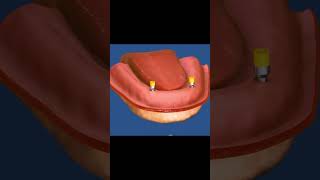 How do snap in dentures work [upl. by Thgiwd141]