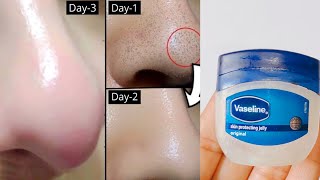 How to remove blackheads and Whiteheads from nose and face naturally at home [upl. by Ocram]