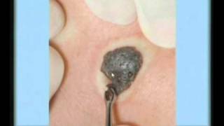 Seborrheic Keratosis Treatment [upl. by Aiker]