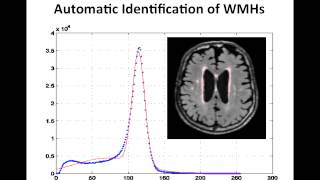 Resolving the White Matter Hyperintensity Prenumbra using FLAIR and Diffusion [upl. by Annalise19]