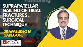 Suprapatellar Nailling of Tibial Fractures Surgical Technique by Dr Wasudeo M Gadegone [upl. by Clarey]