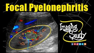 Focal Pyelonephritis in Pregnancy  Ultrasound  CT  Case 192 [upl. by Ahsahs]