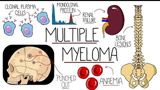 Multiple Myeloma sign and symptoms Treatment Management NCLEXRN REVISION [upl. by Jerrine]