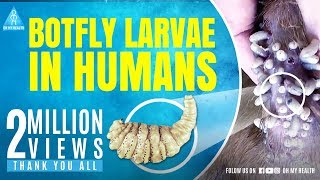 botfly larvae in humans [upl. by Aiuqes923]