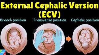 External Cephalic Version ECV  When is it used and how is it done [upl. by Treharne]