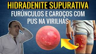 Furúnculos e caroços com pus nas virilhas o sofrimento de quem tem hidradenite supurativa [upl. by Roswell]