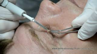 Soft fibroma  removal by highfrequency electrosurgery [upl. by Eittol550]