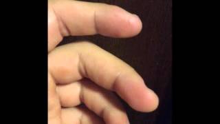 Major fasciculation in middle finger  Muscle twitching [upl. by Abrahams543]