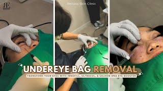 Undereye Bag Removal Transform Your Eyes w our Premium NonSurgical Undereye Rejuvenation Combo [upl. by Emerick349]