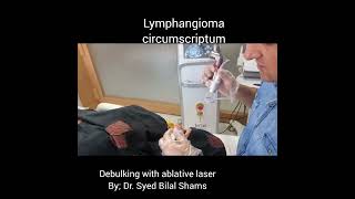 Lymphangioma circumscriptum  laser treatment  Dr Bilal Shams  Dermatologist [upl. by Hcaz]