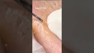 Pickel Ausdrücken Blackheads Akne amp Mitesser entfernen 🔴 45 [upl. by Yun]